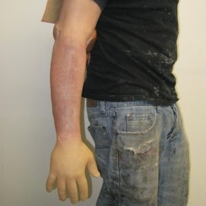 Fracture fermée du bras droit