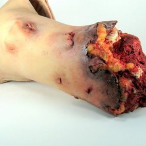Amputation de la jambe